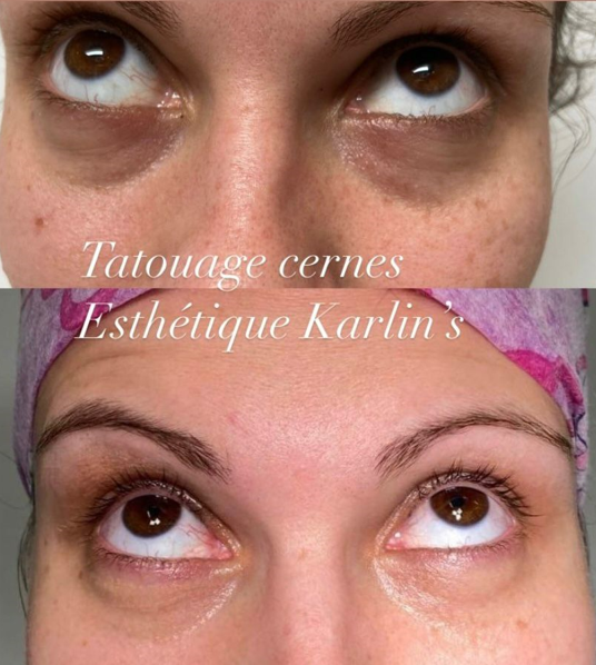 Dermopigmentation sur cernes