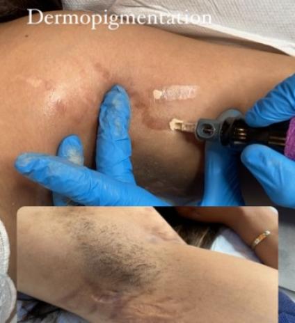Tatouage réparateur 
