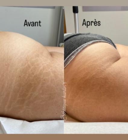 Tatouage réparateur pour les vergetures