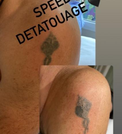 Détatouage