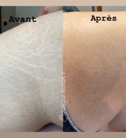 Tatouage réparateur pour les vergetures